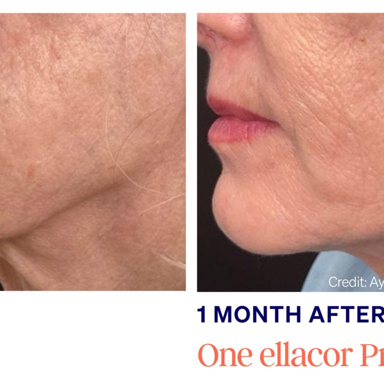 Ellacor 1